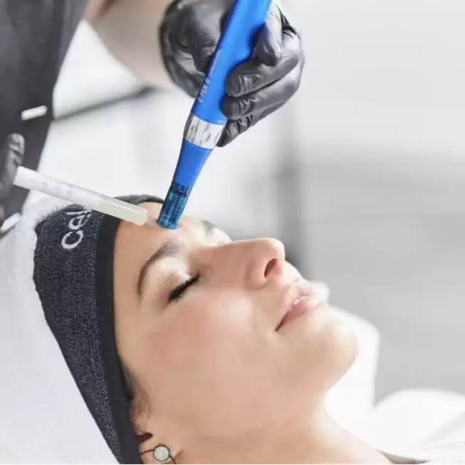 microneedling -  - microneedling