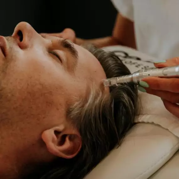 microneedling2 -  - microneedling