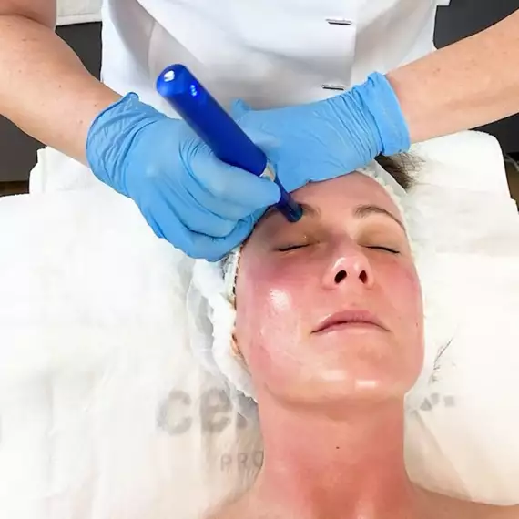 microneedling3 -  - microneedling